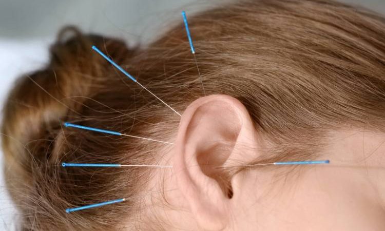 Close up of acupuncture needles in ear during auricular acupuncture